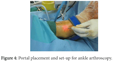 osteoarthritis-Portal-placement-set-up-ankle-arthroscopy