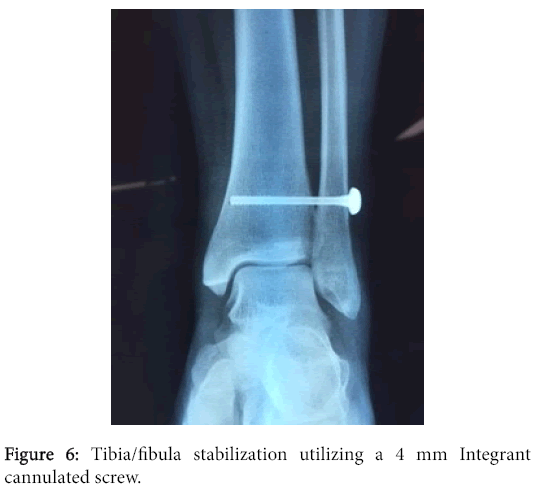 osteoarthritis-Tibia-fibula-stabilization-utilizing