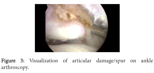 osteoarthritis-Visualization-articular-damage