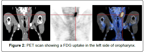 otolaryngology-FDG-uptake