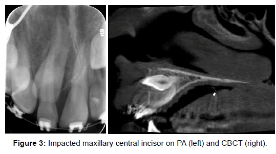 otolaryngology-Impacted-maxillary
