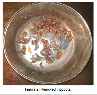 otolaryngology-Removed-maggots