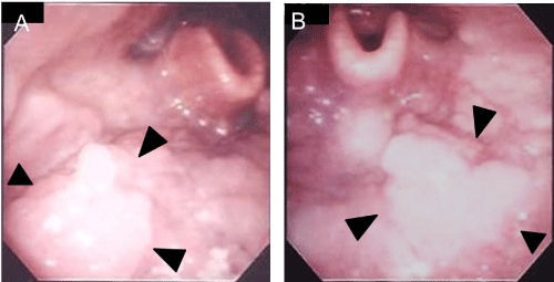 Base of tongue cancer and hpv