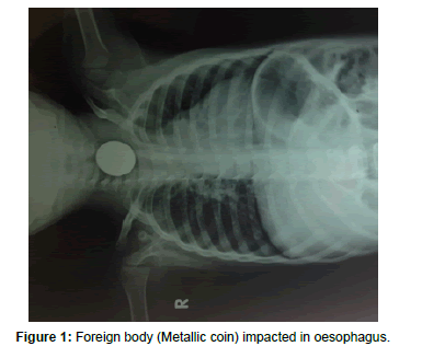 otolaryngology-impacted-oesophagus