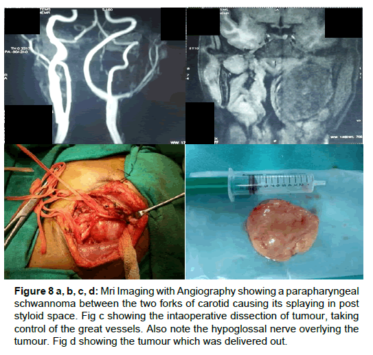 otolaryngology-intaoperative-dissection