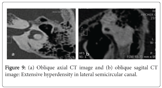 otolaryngology-open-access-Extensive-hyperdensity