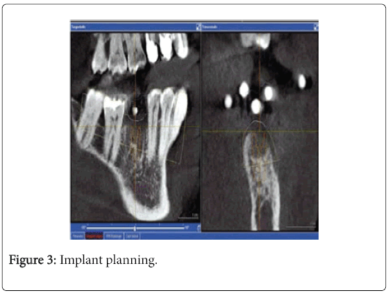 otolaryngology-open-access-Implant-planning