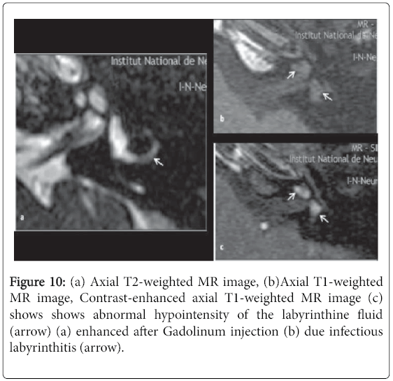 otolaryngology-open-access-MR-image