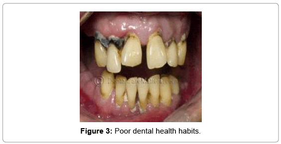 otolaryngology-open-access-Poor-dental