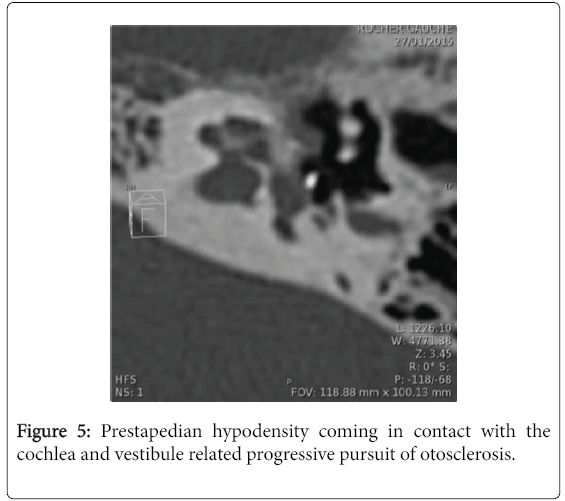 otolaryngology-open-access-Prestapedian-hypodensity