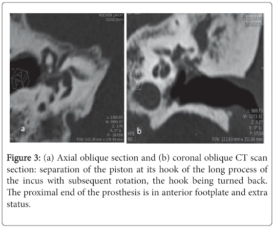 otolaryngology-open-access-coronal-oblique