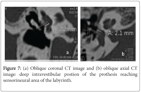 otolaryngology-open-access-deep-intravestibular