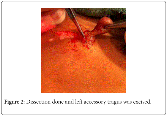 otolaryngology-open-access-left-accessory-tragus