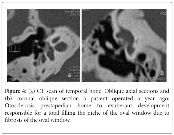 otolaryngology-open-access-temporal-bone