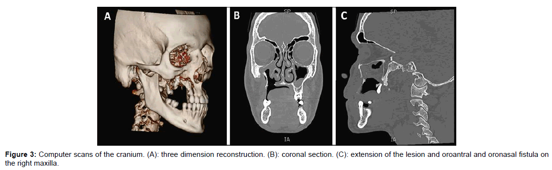 otolaryngology-right-maxilla
