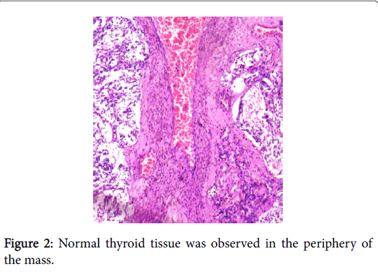 otolaryngology-thyroid-tissue