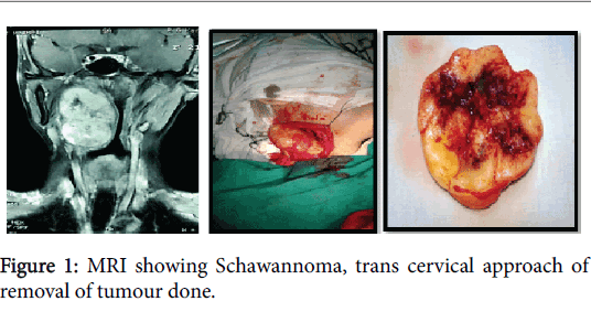 otolaryngology-trans-cervical