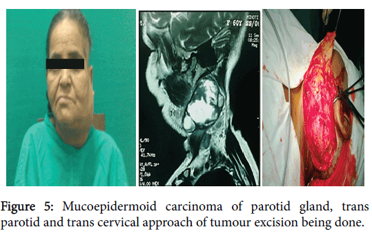 otolaryngology-tumour-excision