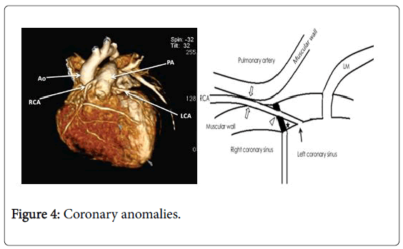 pain-relief-Coronary-anomalies