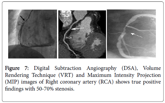 pain-relief-Digital-Subtraction-Angiography