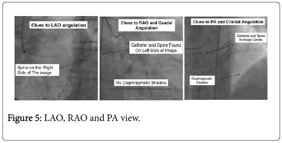pain-relief-LAO-RAO-PA-view