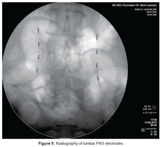 pain-relief-Radiography-lumbar-PNS-electrodes