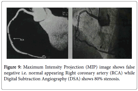 pain-relief-Right-coronary-artery