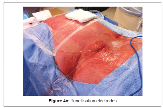 pain-relief-Tunellisation-electrodes
