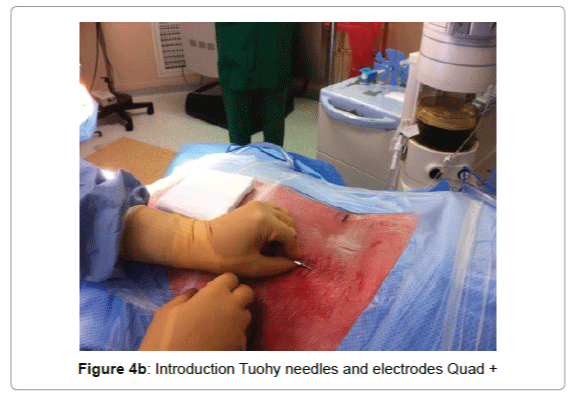 pain-relief-Tuohy-needles-electrodes-Quad