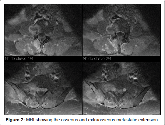 pain-relief-extraosseous