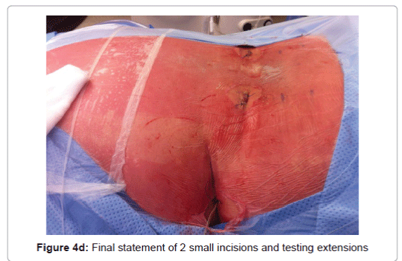 pain-relief-incisions-testing-extensions