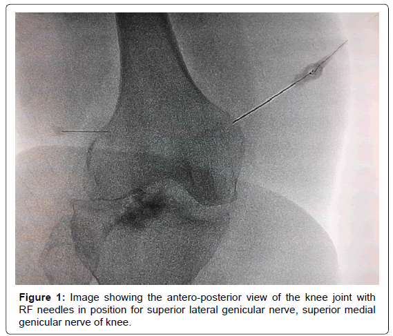 pain-relief-lateral-genicular-nerve