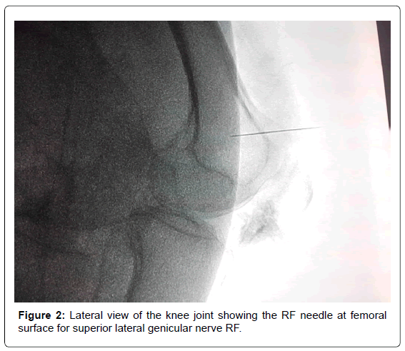 pain-relief-superior-lateral-genicular