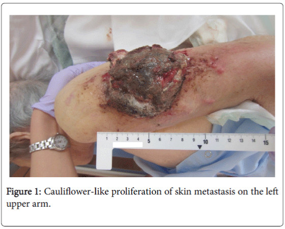 palliative-care-medicine-Cauliflower-like-proliferation