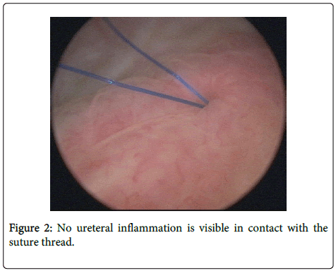 palliative-care-medicine-No-ureteral-inflammation