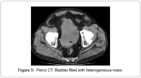 palliative-care-medicine-Pelvic-CT
