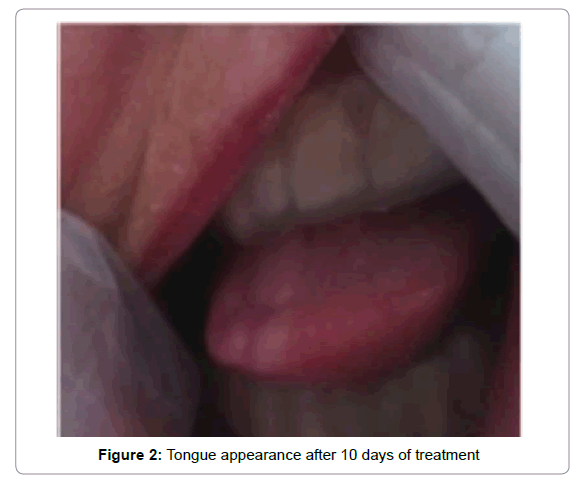 palliative-care-medicine-Tongue-appearance