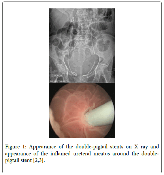 palliative-care-medicine-double-pigtail-stents