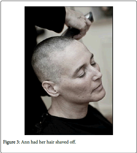 palliative-care-medicine-hair-shaved-off