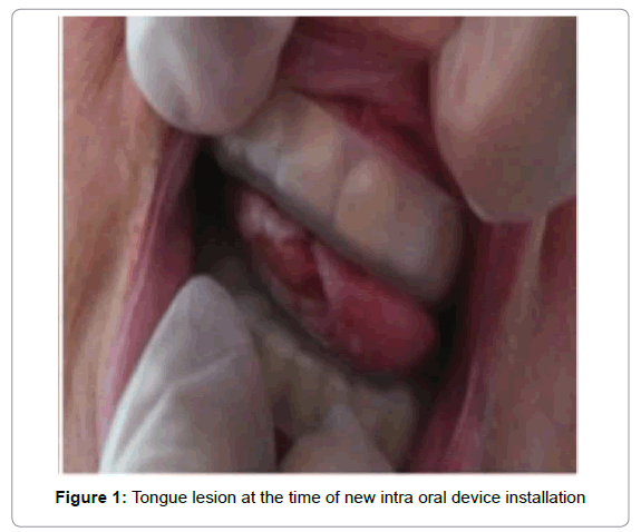 palliative-care-medicine-new-intra-oral-device