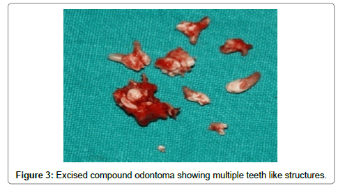 pediatric-dental-care-calcified