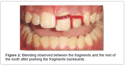 pediatric-dental-care-Bleeding-observed
