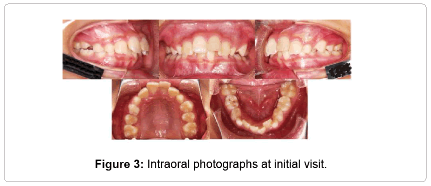 pediatric-dental-care-Intraoral