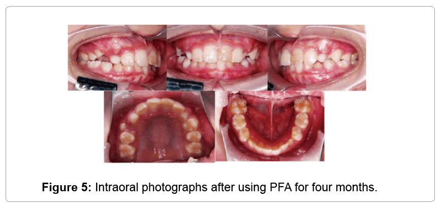 pediatric-dental-care-Intraoral