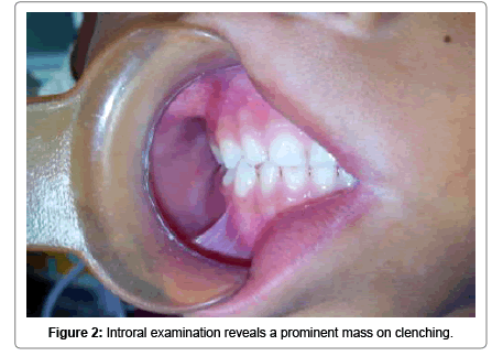 pediatric-dental-care-Introral-examination