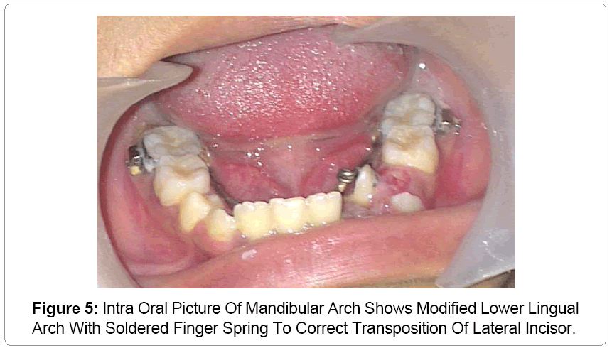 pediatric-dental-care-Mandibular