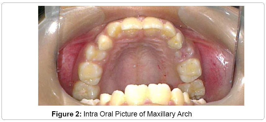 pediatric-dental-care-Maxillary