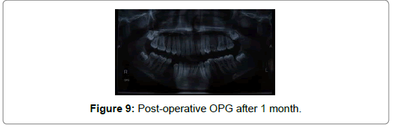 pediatric-dental-care-dentigerous
