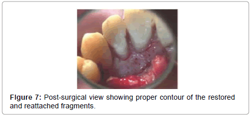 pediatric-dental-care-Post-surgical