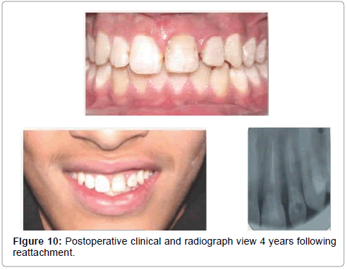pediatric-dental-care-Postoperative-clinical